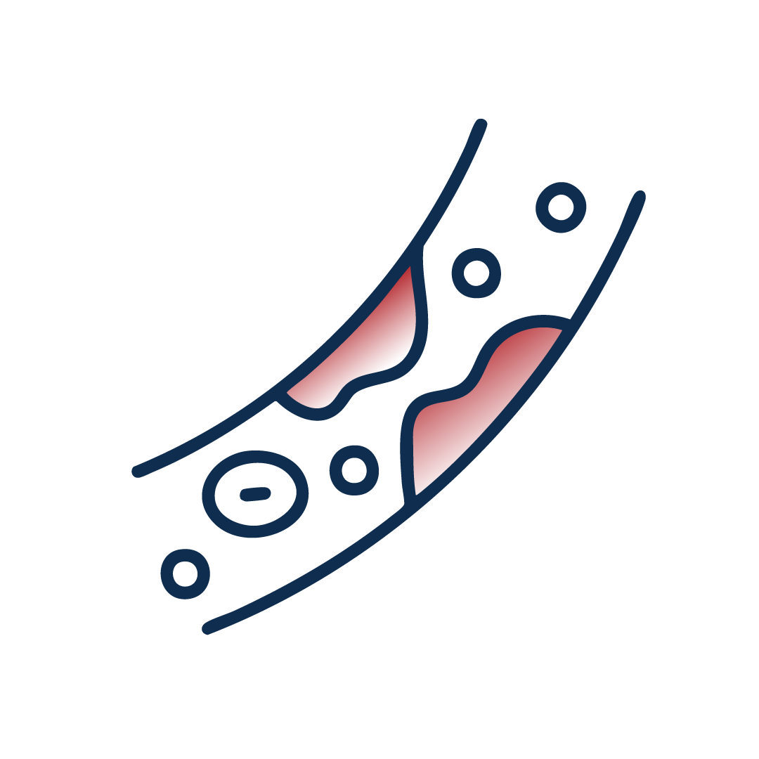 Cholestérol, Athérosclérose